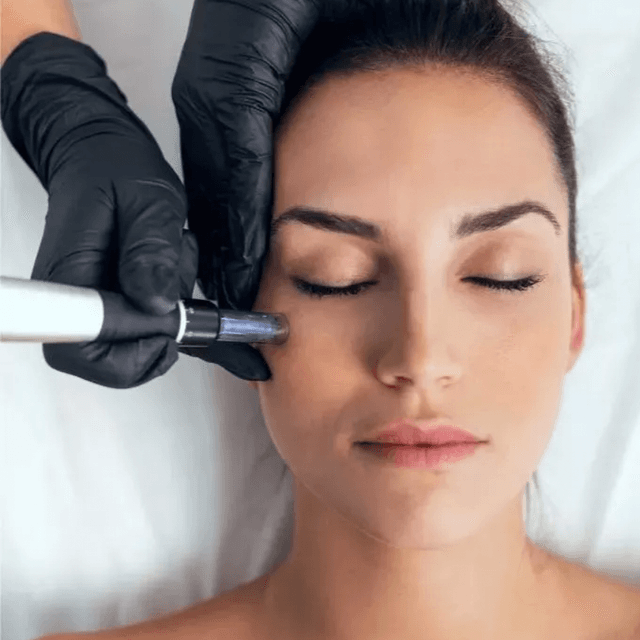 Microneedle Face (3pk) at Skin by Cydni in Atlanta, GA